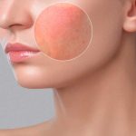 Manejo Cosmetológico de Pieles Sensibles y Reactivas